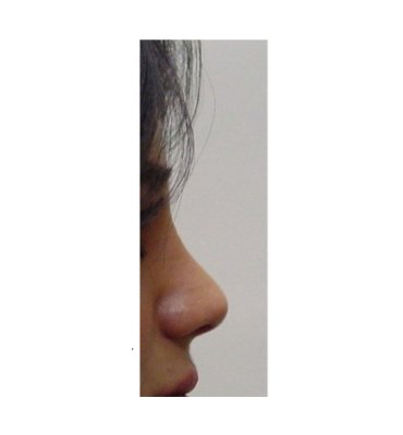 Establishing Balance Through Rhinoplasty After